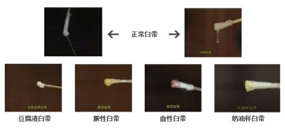 <em>白带多是怎么回事</em>?-山西现代妇产医院